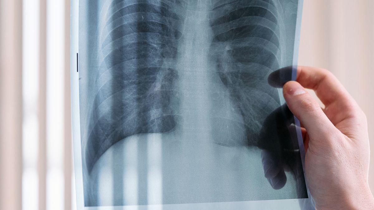 The Canadian Bronchiectasis and NTM Registry